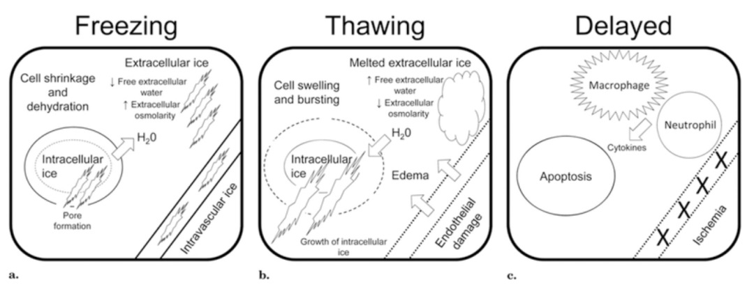 腫瘤治療界的「高冷之花」——腫瘤微創(chuàng)冷凍消融，國產(chǎn)替代設(shè)備空間巨大